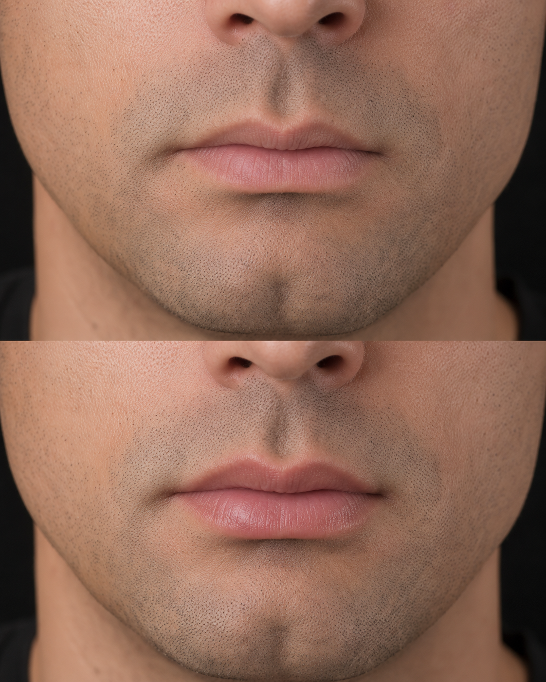 Preenchimento labial masculino