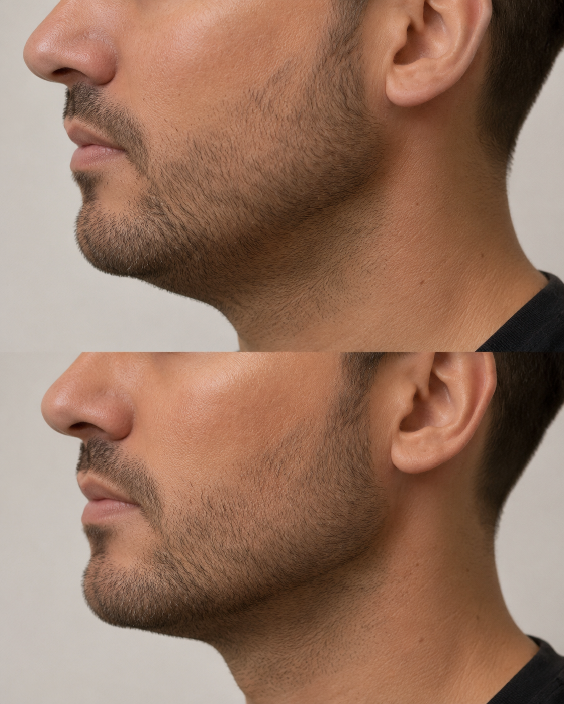 Preenchimento mandibular masculino