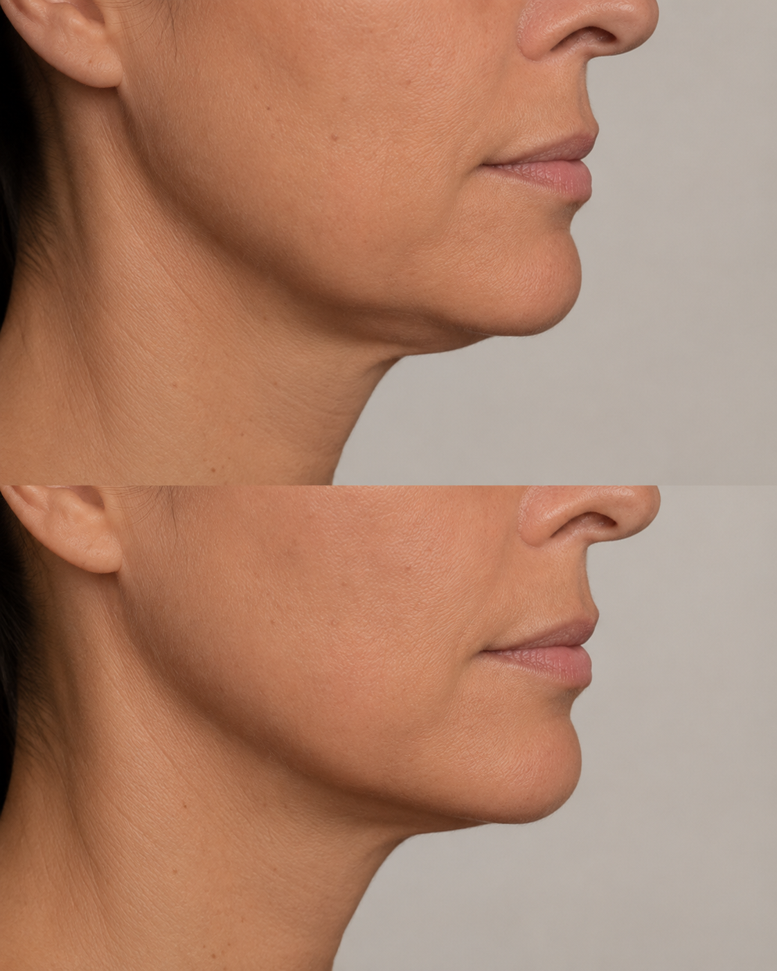 Preenchimento mandibular feminino