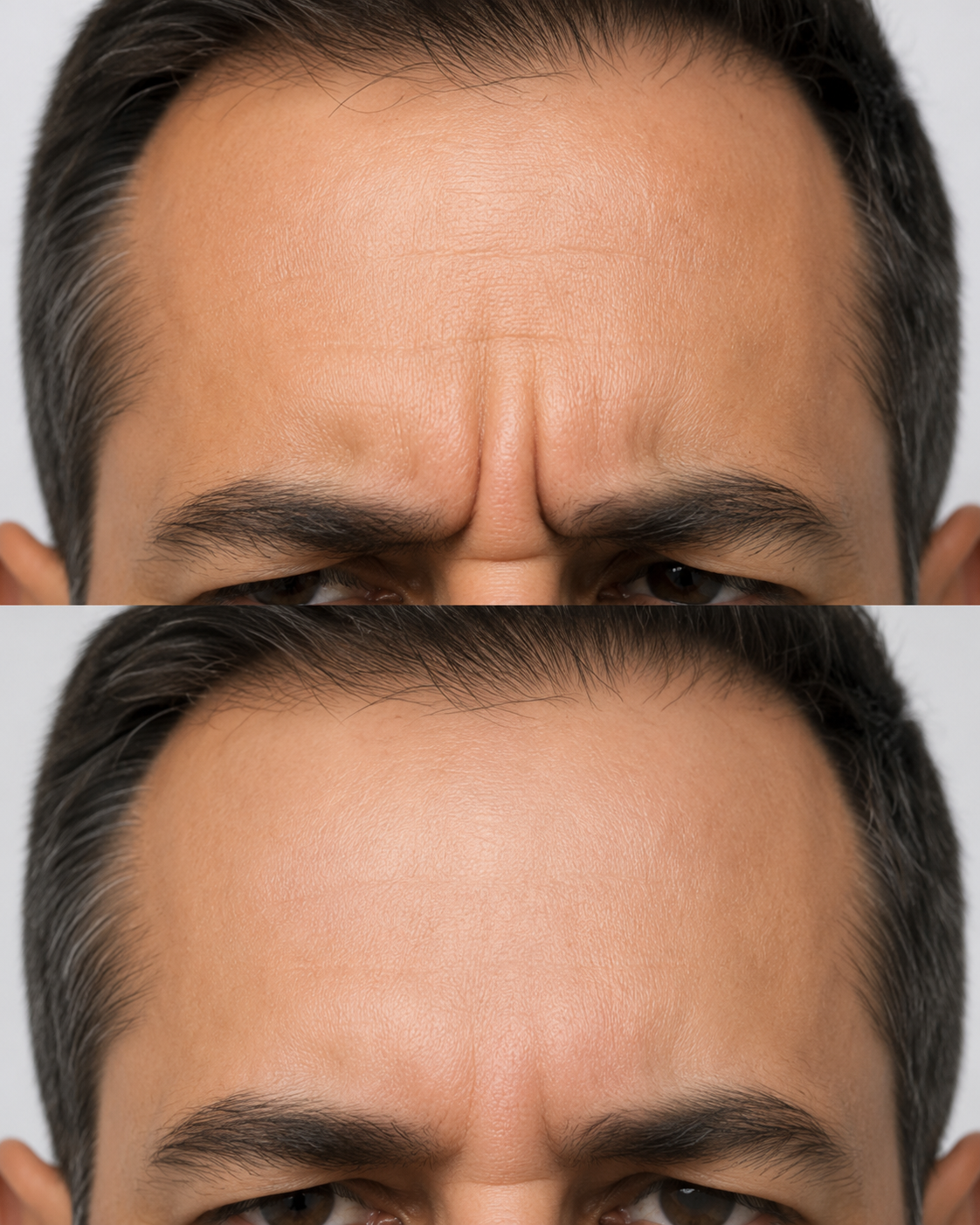 Toxina botulínica masculino